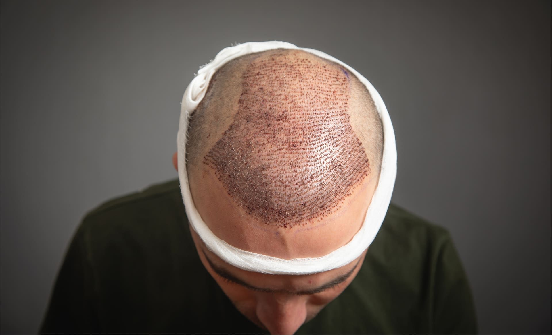 5 VIP-Tipps zur Beschleunigung der Genesung nach einer Haartransplantation