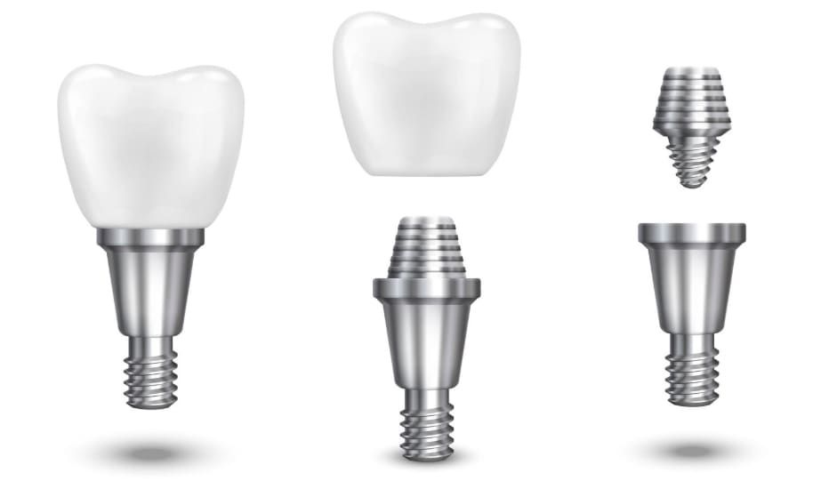 Implantate & Smile Design